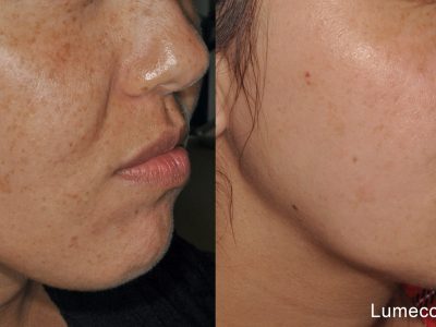 lumecca-before-after-dr-v-ross-preview-3