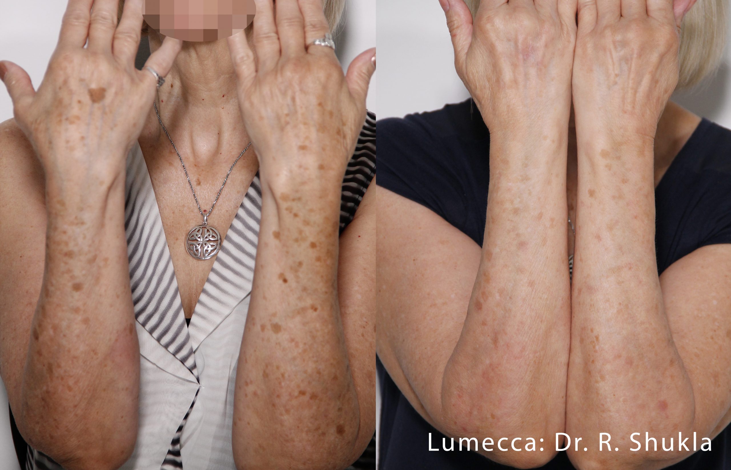 lumecca-before-after-dr-r-shukla-preview-9