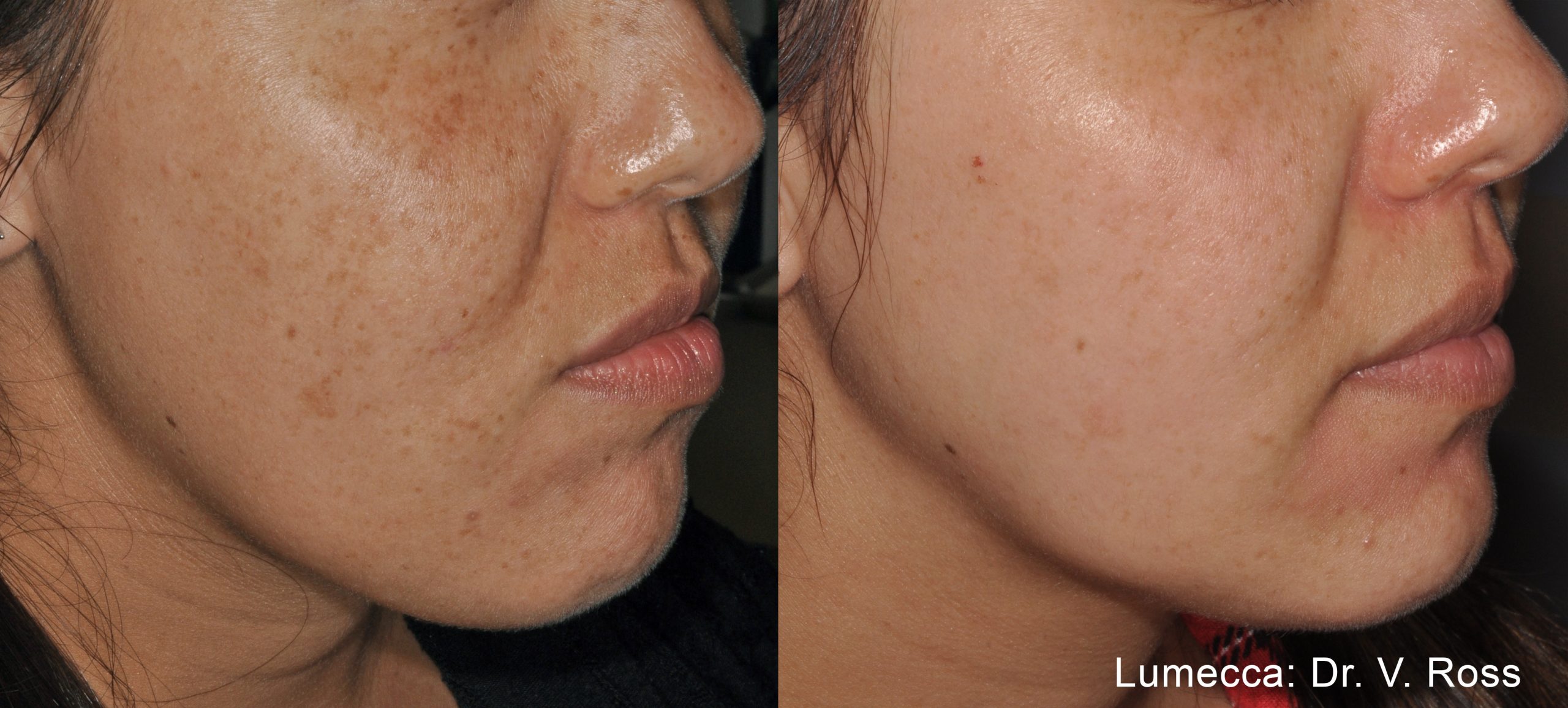 lumecca-before-after-dr-v-ross-preview-3